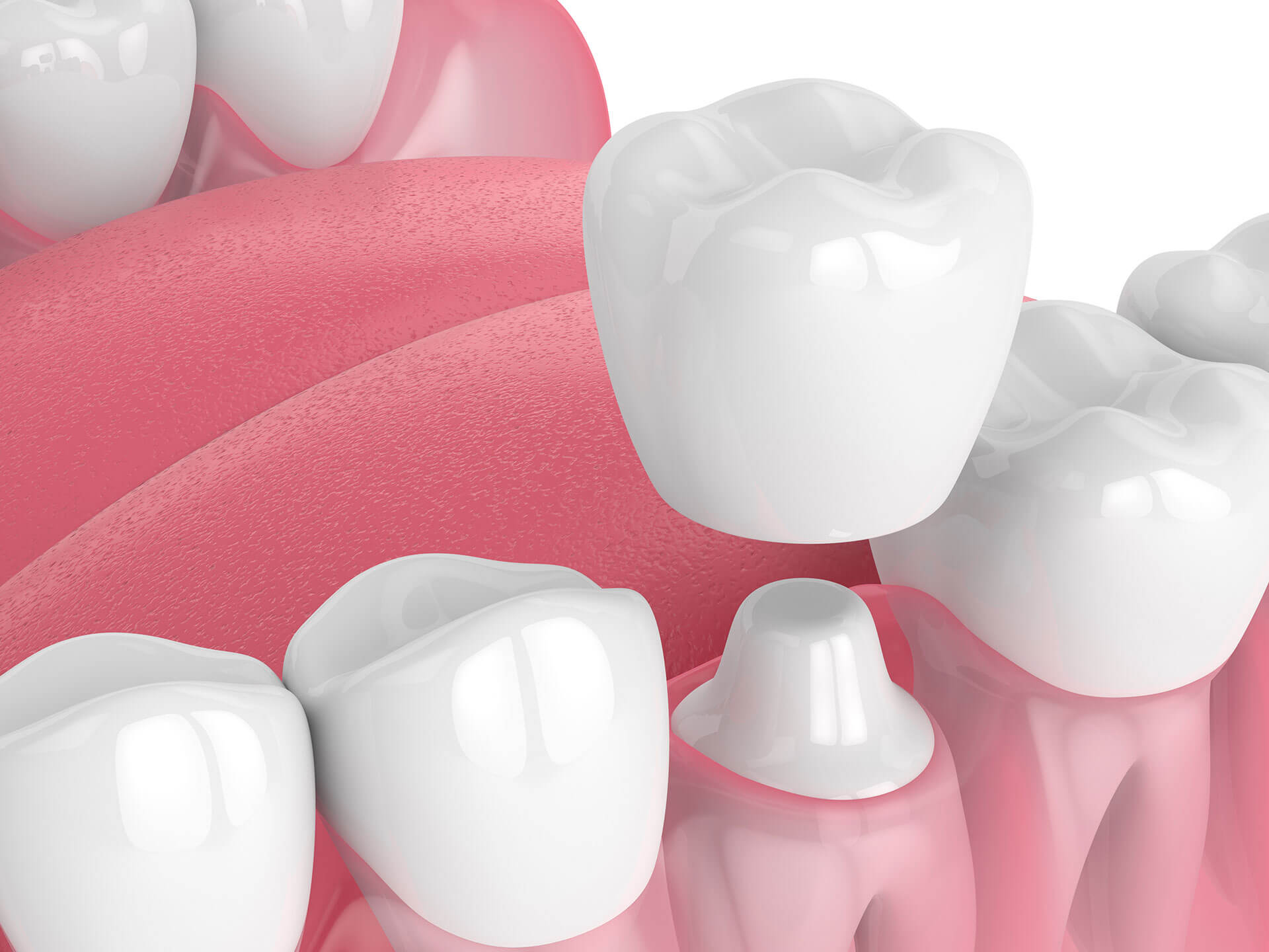 What Are the Benefits of Visiting Dental Crowns Houston?