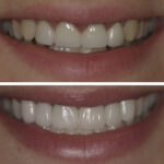 dental implant Manhattan
